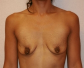 Feel Beautiful - Breast Augmentation San Diego Case 51 - Before Photo